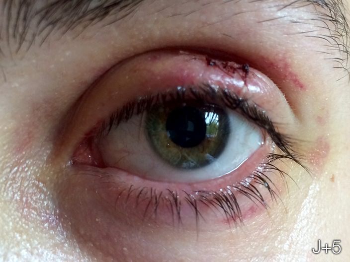 Chalazion surgery step 7